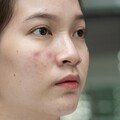 26歲女業務臉爛到不敢見人，醫揭2招逆轉肌膚危機