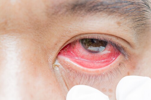眼睛癢到想抓爆？小心是「這些日常東西」害的 你每天都在接觸卻不知道