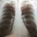 肺炎鏈球菌創6年新高！專家揭「13價+23價疫苗」接種懶人包 符合這些條件免費打