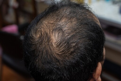 植髮毛囊「後枕、側枕、鬍鬚、身體毛」取哪裡最好？ 醫揭存活率、髮質效果差異