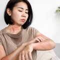 全台25萬人中鏢！蕁麻疹「6大高危隱形誘因」曝 洗冷水、心情差都可能誘發