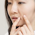 用「這1類抗痘藥」外出別忘擦防曬！專家示警 痘痘治療指南看這