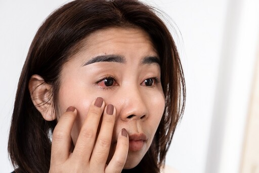 眼妝沒卸乾淨？醫警告「恐釀4大眼部傷害」 嚴重恐損視力