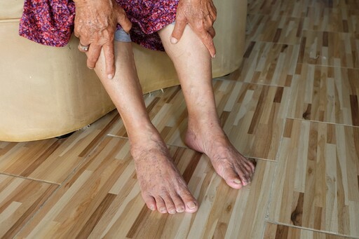 一到下午腿浮腫怎麼辦？ 醫授「3招」改善靜脈循環：多喝水也有用