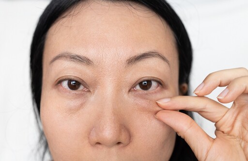 眼袋手術效果能維持多久？醫揭真相 做好這1件事撐更久