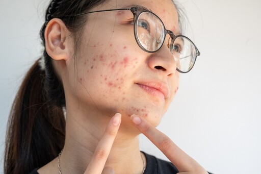 臉上狂冒痘？皮膚科醫曝「這天數」內消除才能不留痕 千萬別用手擠