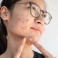 臉上狂冒痘？皮膚科醫曝「這天數」內消除才能不留痕 千萬別用手擠