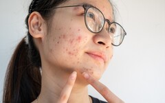 臉上狂冒痘？皮膚科醫曝「這天數」內消除才能不留痕 千萬別用手擠