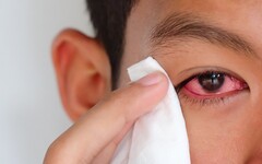 眼睛過敏怎麼處理最快?紅腫、流淚「這樣做」馬上緩解 千萬別揉