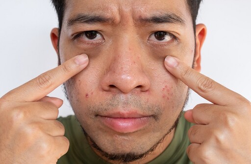 熬夜害黑眼圈？專家揭「更多隱藏原因」超錯愕 多吃這些食物自救