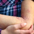 花錢找偏方反增痛苦！異膚病友呼籲：回歸正規治療才是長期解方