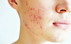 滿臉痘痘怕見同學？皮膚科醫師教青少年正確抗痘方法
