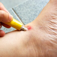 外用類固醇藥膏「這樣用」恐誘發糖尿病！藥師示警 擦多不會更快好
