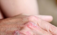 乾癬反覆發作別害怕！醫師教你 7 大預防誘發因子