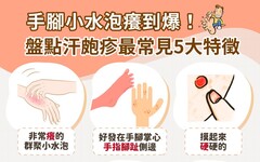 汗皰疹會自己好嗎？擦藥膏凡士林有用嗎？汗皰疹原因治療、初期症狀和香港腳有什麼不同？