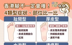 香港腳症狀會自己好嗎？會傳染到手和臉嗎？香港腳藥膏推薦怎麼擦？真正治療香港腳水泡脫皮方法