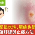 手掌腳掌長水泡、膿皰也是「乾癬」症狀！醫教正確舒緩與止癢方法