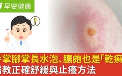 手掌腳掌長水泡、膿皰也是「乾癬」症狀！醫教正確舒緩與止癢方法