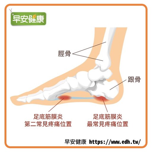 足底筋膜炎症狀多久會好？治療該看哪科？從足底筋膜炎原因與疼痛位置，開始了解舒緩按摩、鞋子挑選方法