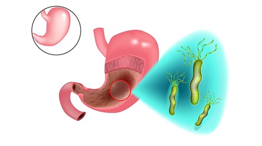 別輕忽幽門螺旋桿菌感染，恐會得胃癌