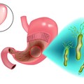 別輕忽幽門螺旋桿菌感染，恐會得胃癌