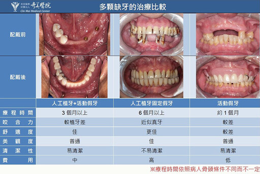 男子牙周病嚴重！戴活動假牙難進食 裝人工植體才改善
