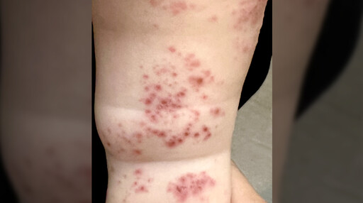 腸病毒威脅不分季節 病童高燒超過39度、皮膚長滿紅疹