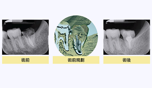 缺牙不治療恐影響外觀 自體牙移植有助恢復咬合與美貌