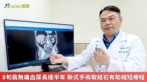 8旬翁無痛血尿長達半年 新式手術取結石有助縮短療程