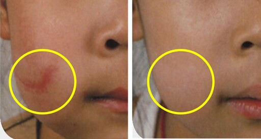 女童右臉因撞擊造成7公分疤痕！ 接受1治療重新展笑顏