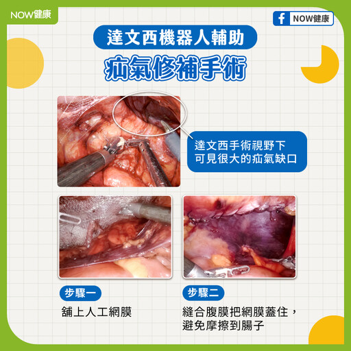 4旬男疝氣困擾多年開了3次刀 達文西微創手術終結復發