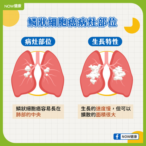 「這族群」肺鱗癌風險增！免疫標靶接力治療 力拚存活