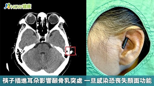 筷子插進耳朵影響顳骨乳突處 一旦感染恐喪失顏面功能