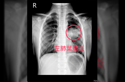 黴漿菌肆虐！醫曝：半數住院病童中鏢 肺部X光白一片