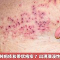 如何分辨單純疱疹和帶狀疱疹？ 出現瀰漫性病灶是警訊