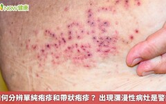 如何分辨單純疱疹和帶狀疱疹？ 出現瀰漫性病灶是警訊