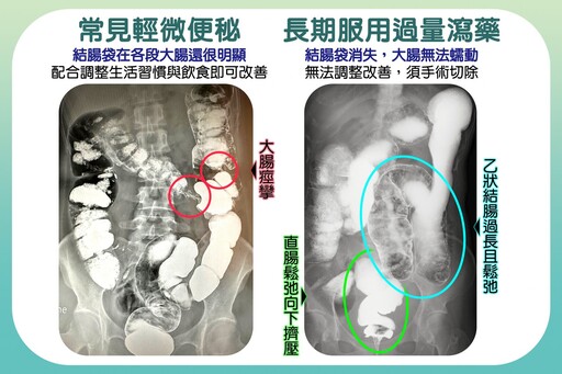 錯誤瘦身導致腸道失能！ 醫同時解決身心問題根除病灶