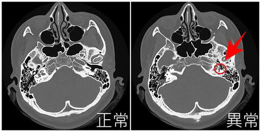 婦人耳膜完好卻中度聽損 CT一照為「耳硬化症」作祟