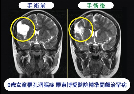 電腦3D導航神助攻 醫師精準執刀助女童擺脫孔洞腦症