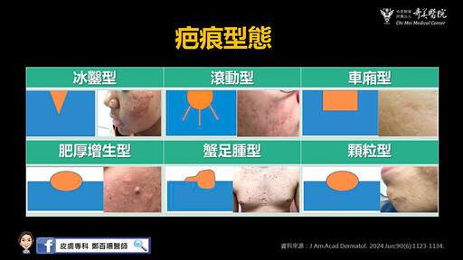 青春痘長大就會好？男大生聽信長輩建言 滿臉痤瘡痘疤