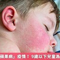 日本爆發「蘋果病」疫情！ 9歲以下兒童為主要受害者