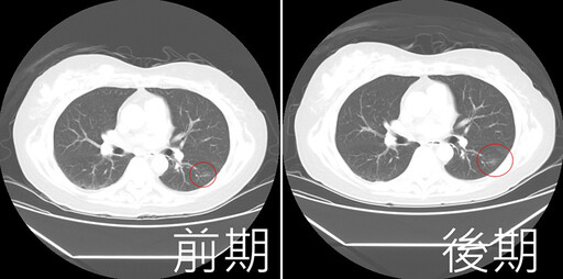 肺結節無痛無感易輕忽 阿嬤懶回診2年後確定罹肺腺癌