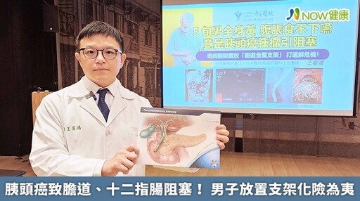 胰頭癌致膽道、十二指腸阻塞！ 男子放置支架化險為夷