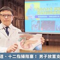 胰頭癌致膽道、十二指腸阻塞！ 男子放置支架化險為夷