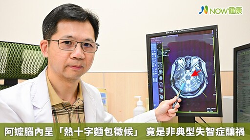 阿嬤腦內呈「熱十字麵包徵候」 竟是非典型失智症釀禍