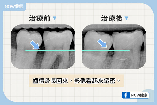 青壯年也會有的隱形慢性牙周病！ 微創牙周治療新選擇
