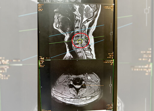 50歲男手麻又無力竟是頸椎病變！ 嚴重恐導致神經壞死