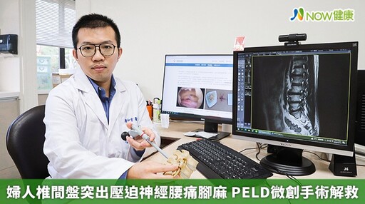 婦人椎間盤突出壓迫神經腰痛腳麻 PELD微創手術解救