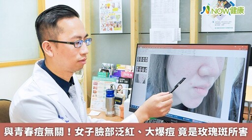 與青春痘無關！女子臉部泛紅、大爆痘 竟是玫瑰斑所害