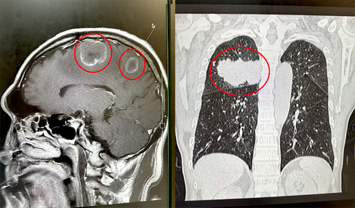 走路偏斜竟是肺癌腦轉移！ 肢體無力等神經症狀別輕忽